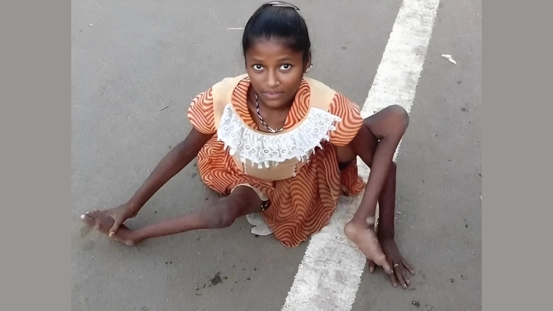 Learn Polio facts about Poliomyelitis (Polio) today