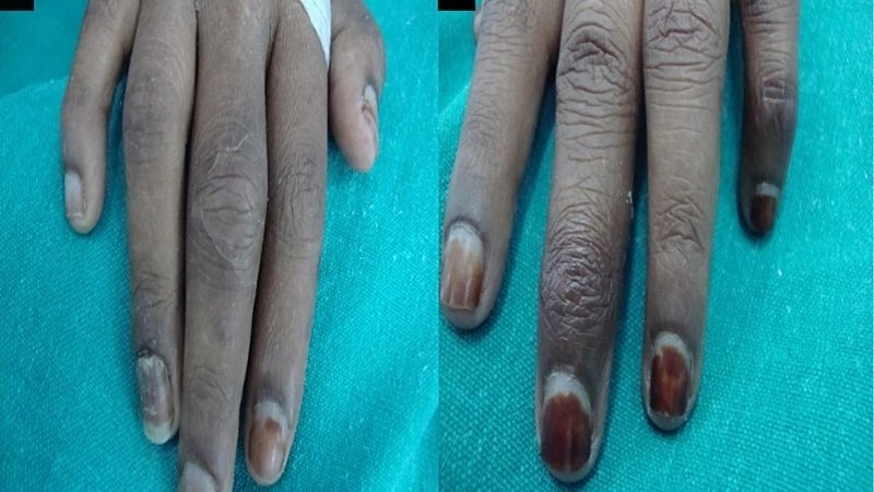 Polyarteritis Nodosa treatment with medical therapy