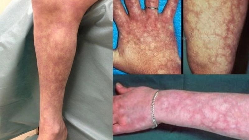 Polyarteritis Nodosa diagnosis using clinical tests