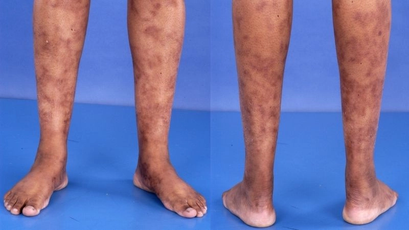 Polyarteritis Nodosa vs vasculitis key differences