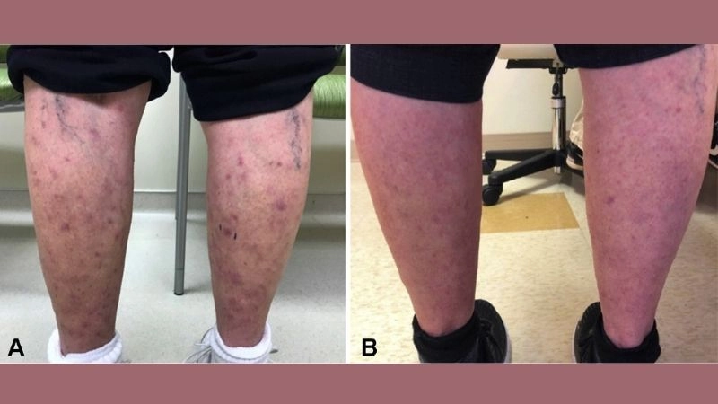 Cutaneous Polyarteritis Nodosa with skin involvement