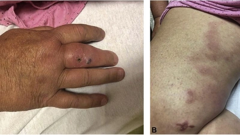 Polyarteritis Nodosa prognosis and patient outlook