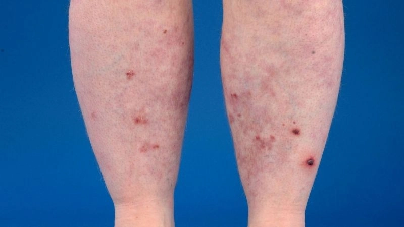 Polyarteritis Nodosa rash as an early warning sign