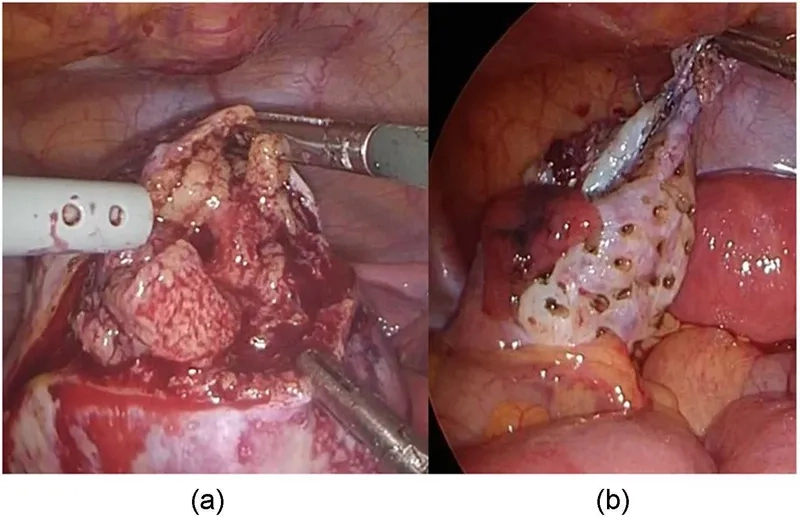 Illustration of hirsutism in women