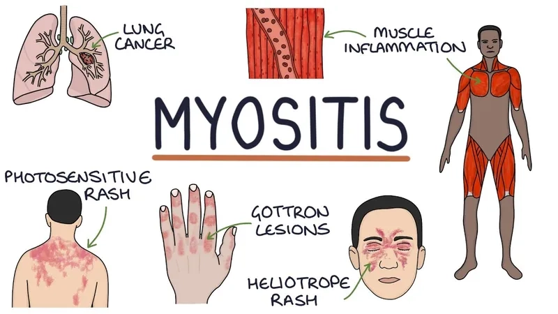An illustration explaining what is polymyositis