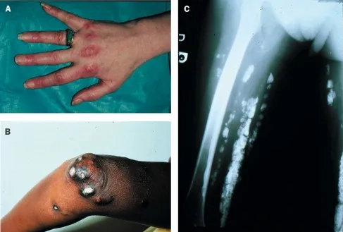 A patient discussing polymyositis treatment options with a doctor