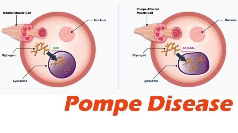 New hope shines in pompe disease treatment