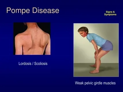 Common symptoms of Pompe disease in patients