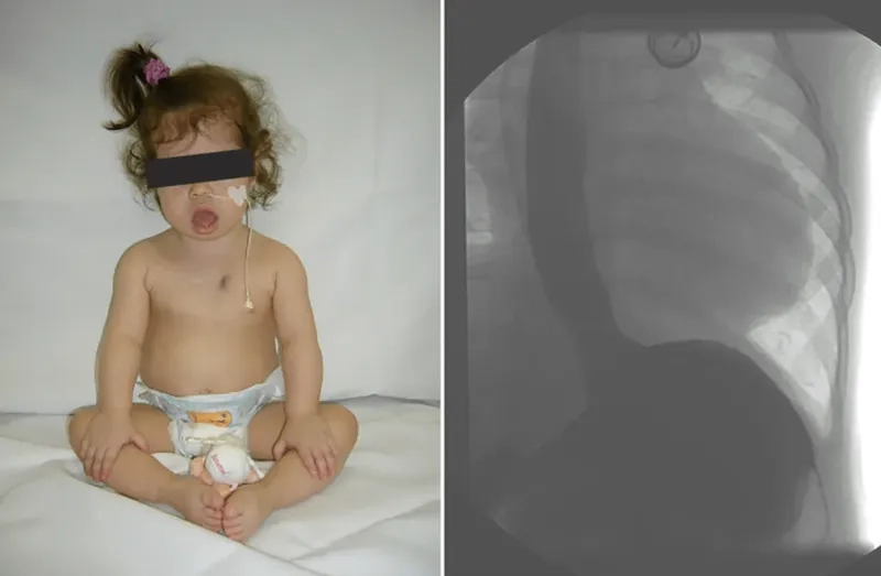 Pompe disease impact on life expectancy