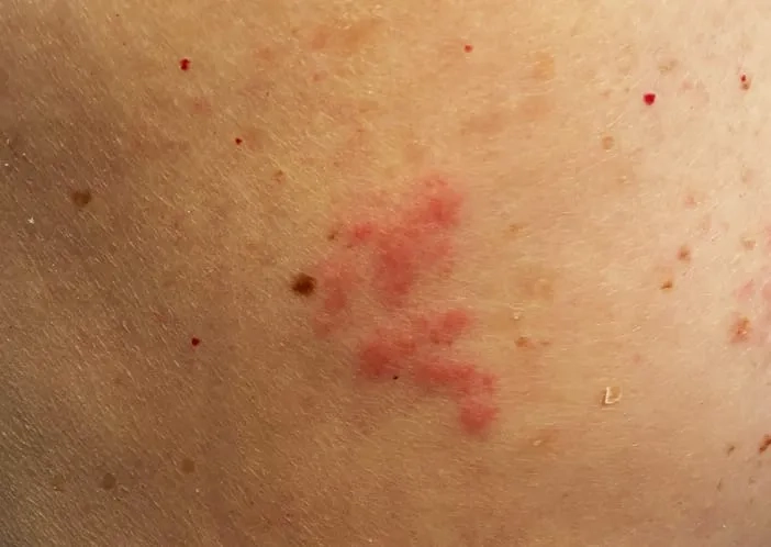 A photo of a lidocaine patch for pain relief