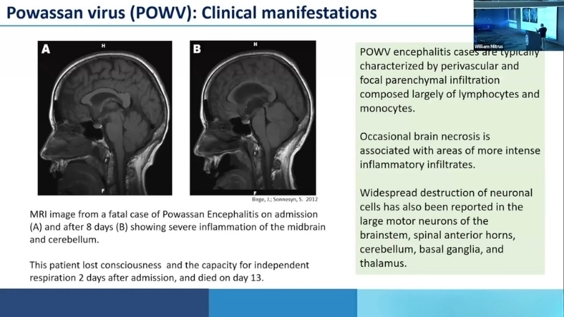Explore Powassan virus symptoms early detection matters