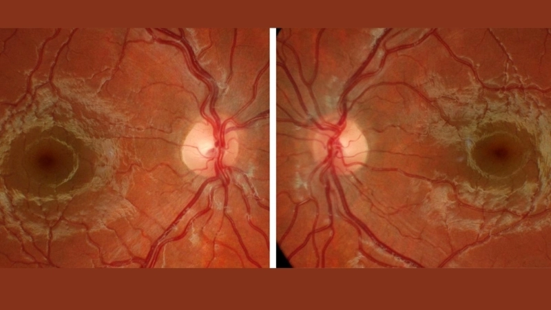 Map showing Powassan virus geographical distribution info