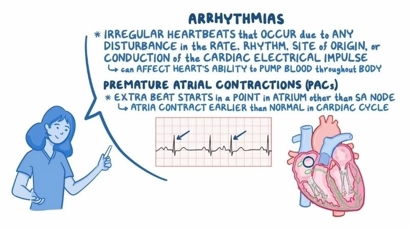 PAC symptoms include fluttering or skipped heartbeats