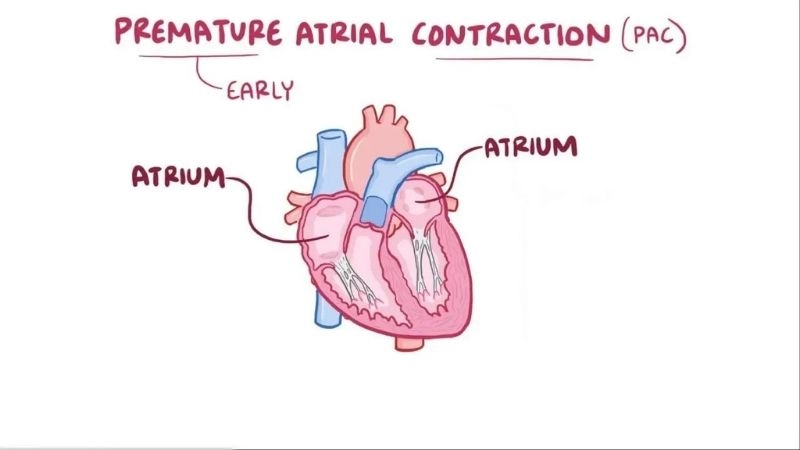Causes of PACs range from stress caffeine to heart disease