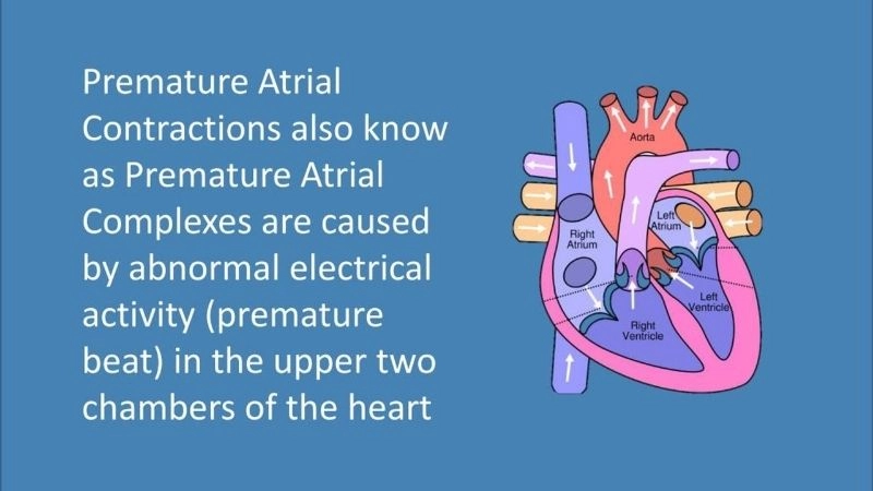Premature atrial contractions during pregnancy need careful monitoring