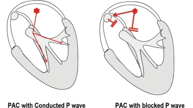 PAC vs PVC shows atrial versus ventricular origin differences