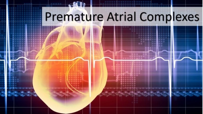 Premature atrial contractions and exercise need careful observation