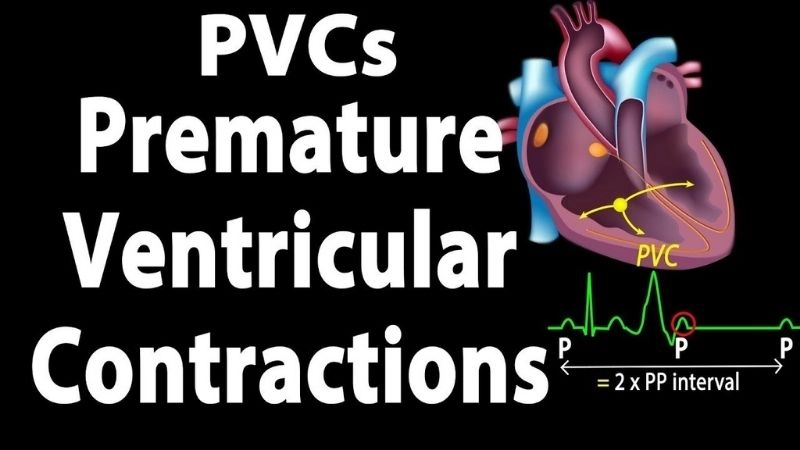 Premature Ventricular Contractions (PVCs) causes and risks