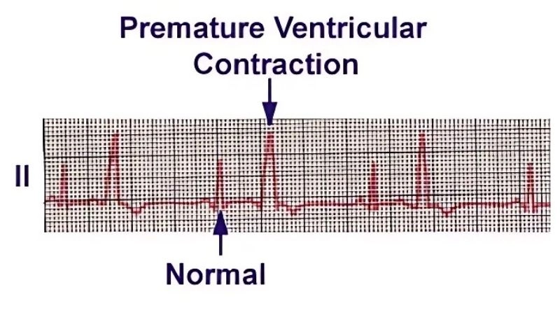 Premature ventricular contractions treatment manages rhythm