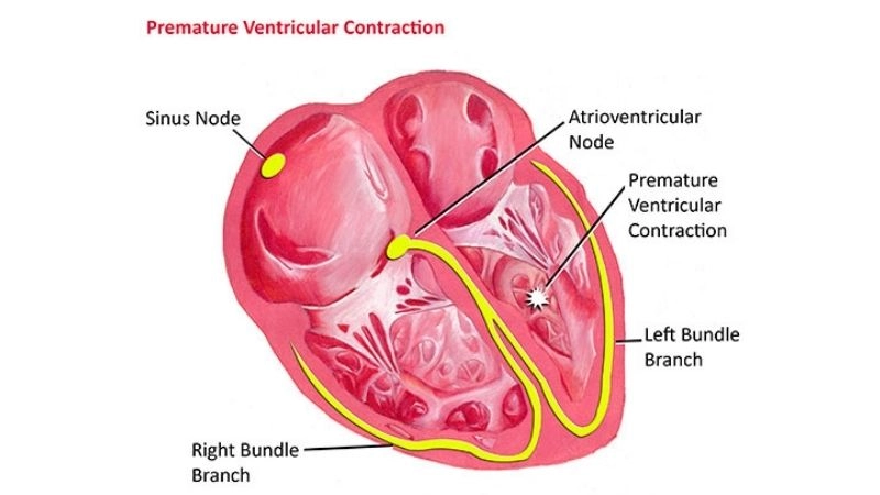 Causes of premature ventricular contractions include stress and caffeine