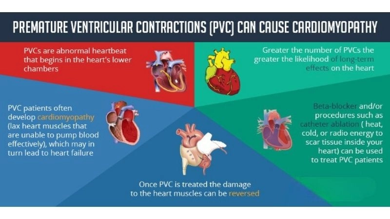 Premature ventricular contractions anxiety worsens palpitations