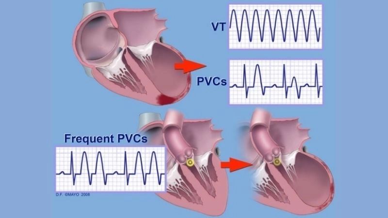 Premature ventricular contractions ECG shows early wide QRS