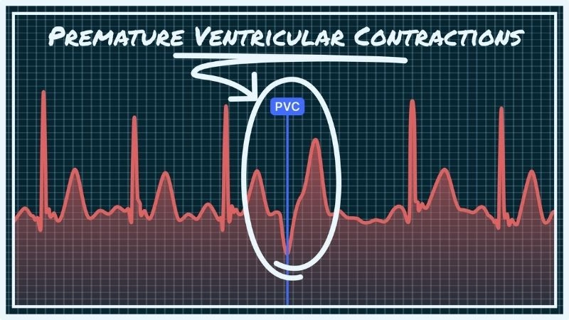 Premature ventricular contractions in athletes may be harmless