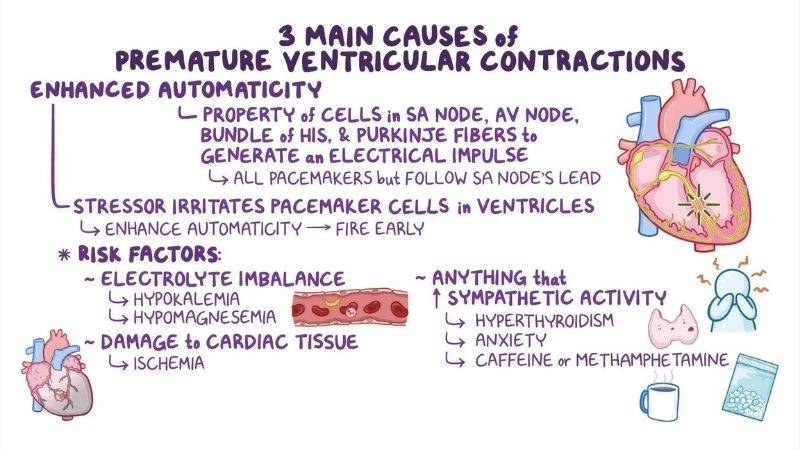 Premature ventricular contractions and caffeine trigger episodes