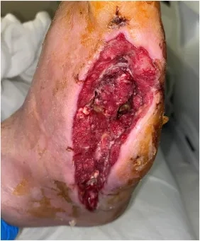 A petri dish culture of anaerobic bacteria in a lab