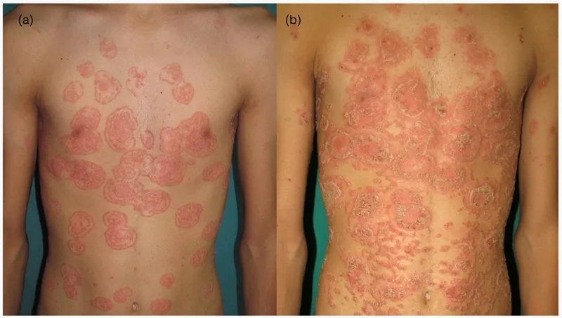 Patient care in common variable immunodeficiency CVID