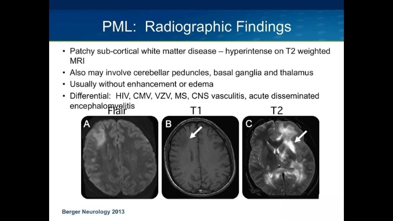 Progressive multifocal leukoencephalopathy cases show severe brain lesions