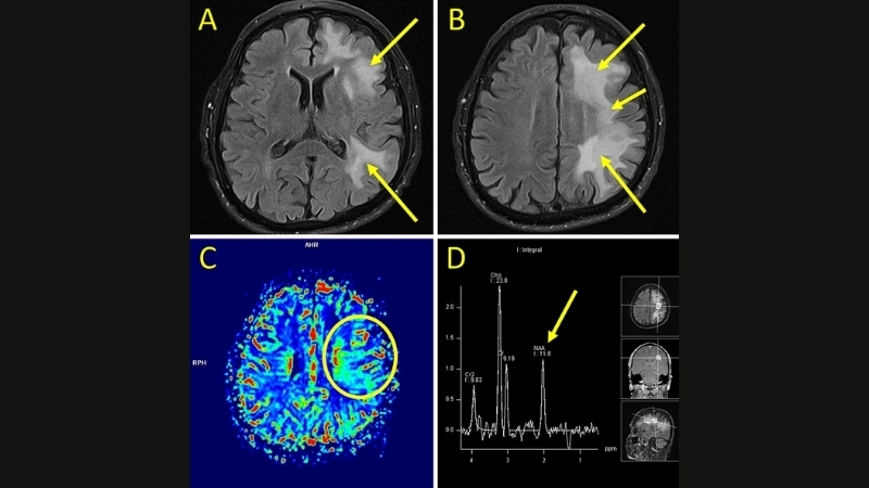 PML treatment focuses on antiviral and immune therapy