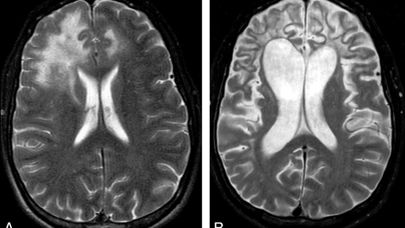 PML multiple sclerosis risk increases with natalizumab therapy