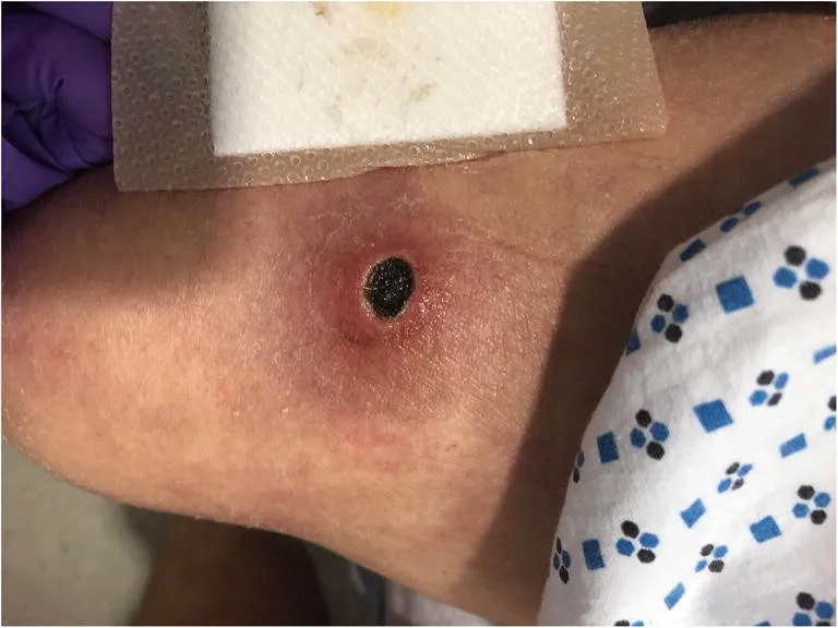 A skin rash showing hot tub folliculitis