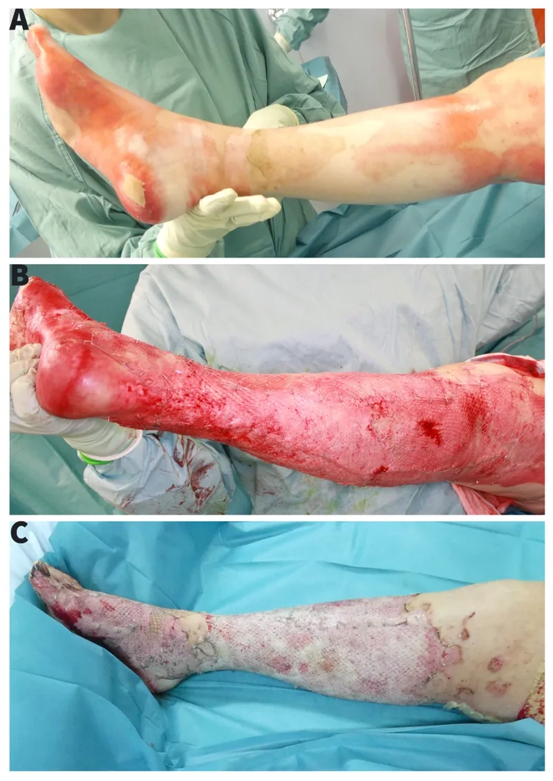 Pseudomonas in lungs of a cystic fibrosis patient