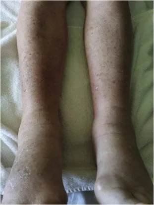 A patient showing early symptoms of psittacosis