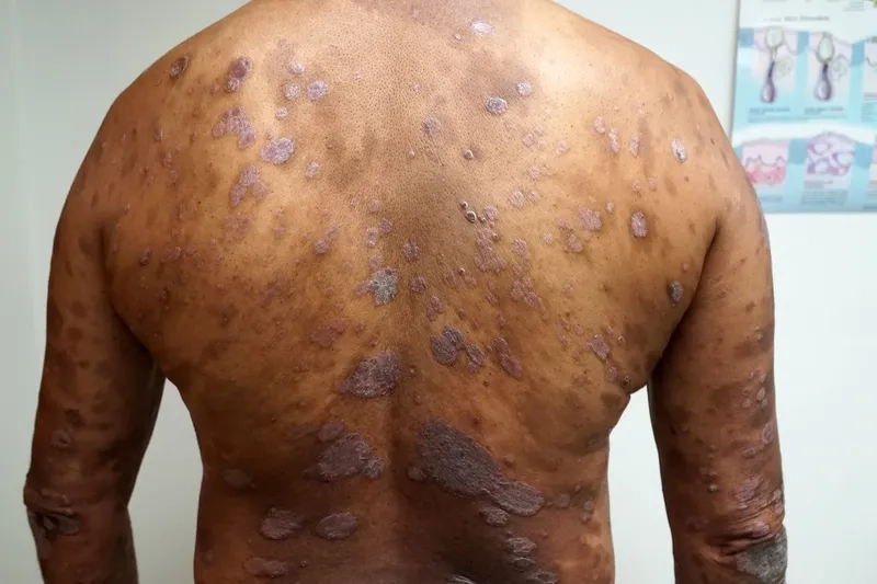 The characteristic spots of guttate psoriasis