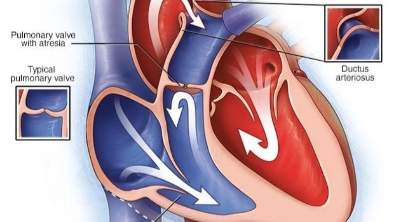 Pulmonary atresia treatment medical and surgical options