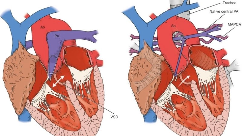 Pulmonary atresia in adults rare long term cases