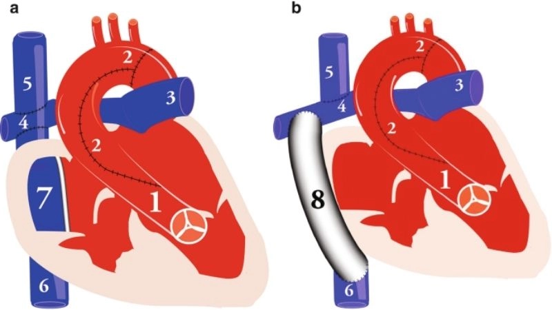 Pulmonary atresia in newborns early detection and care
