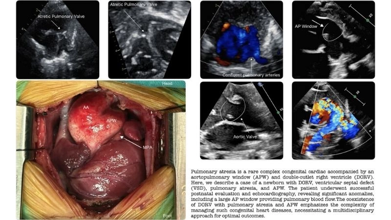 Pulmonary atresia life expectancy survival outlook