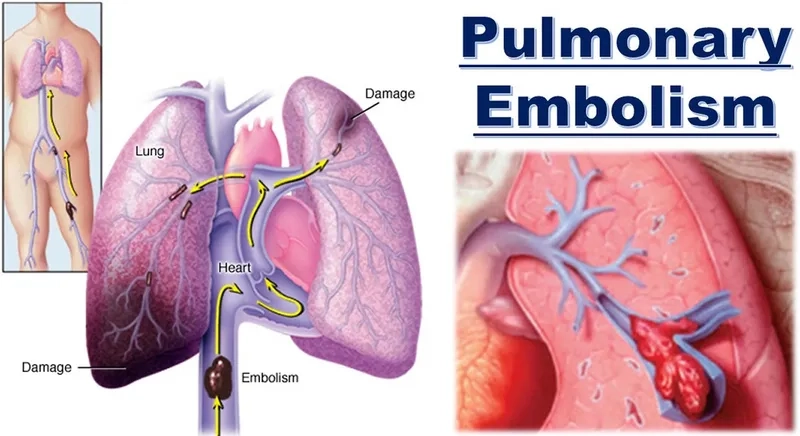 A chart showing the critical signs of pulmonary embolism