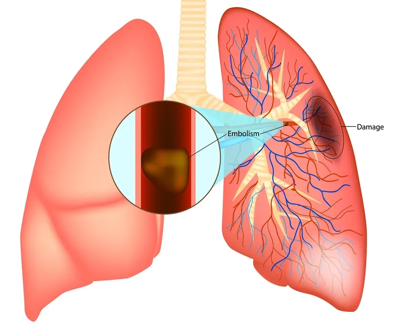 A CT scan for a definitive pulmonary embolism diagnosis