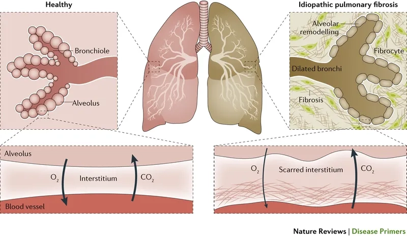 Infographic illustrating stages of pulmonary fibrosis