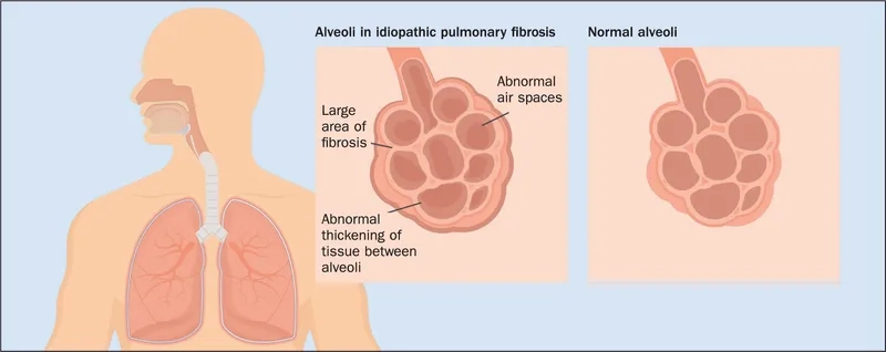 Medical team reviewing pulmonary fibrosis treatment options