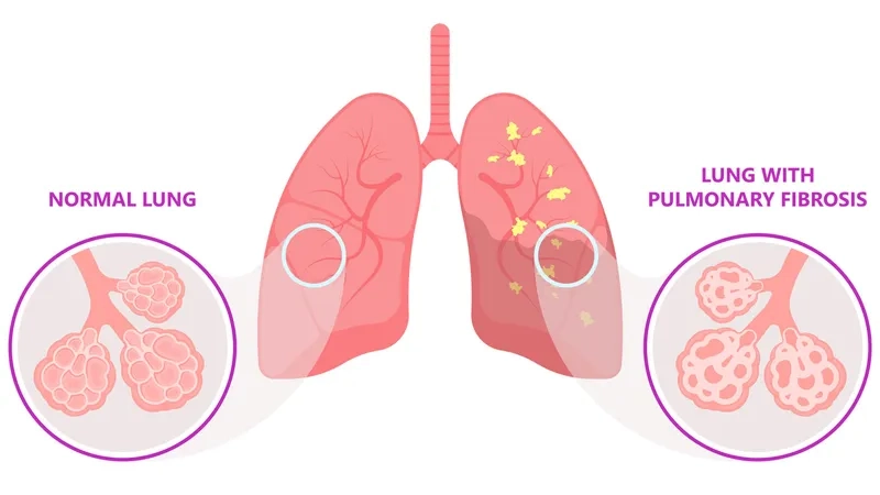 Doctor discussing idiopathic pulmonary fibrosis (IPF) diagnosis