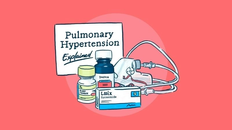 Pulmonary embolism and DVT strong clinical link