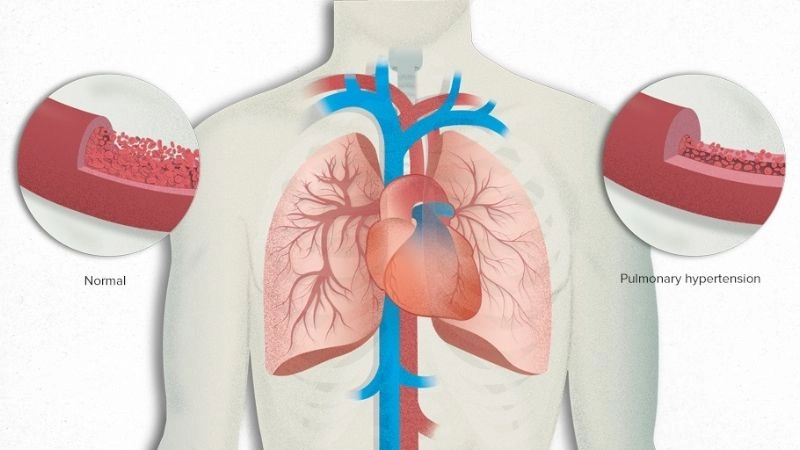 Pulmonary embolism risk factors to be aware of