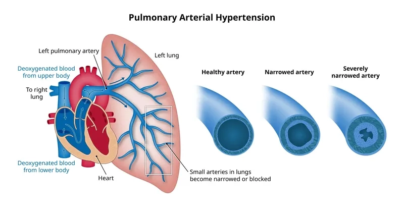 How do pulmonary hypertension patients die explained