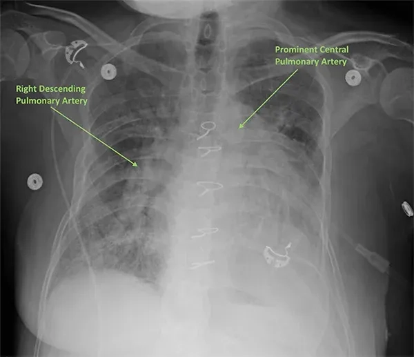 Who pulmonary hypertension groups and categories